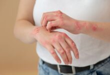 علت و درمان بیماری اگزما پوستی چیست؟